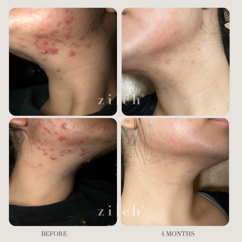 Zilch Acne Formula